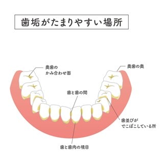 歯に付着する細菌やその代謝物の塊である歯垢がつきやすい場所