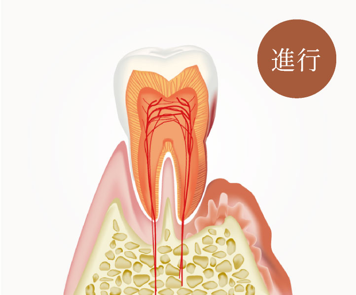 進行