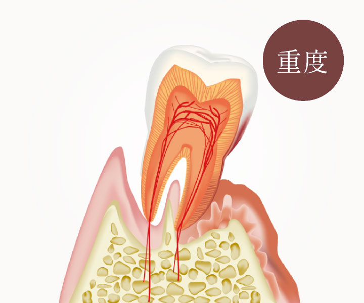 重度